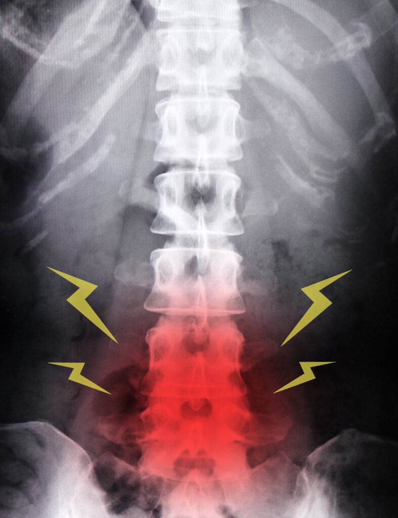腰痛の疾患についてのレントゲン写真